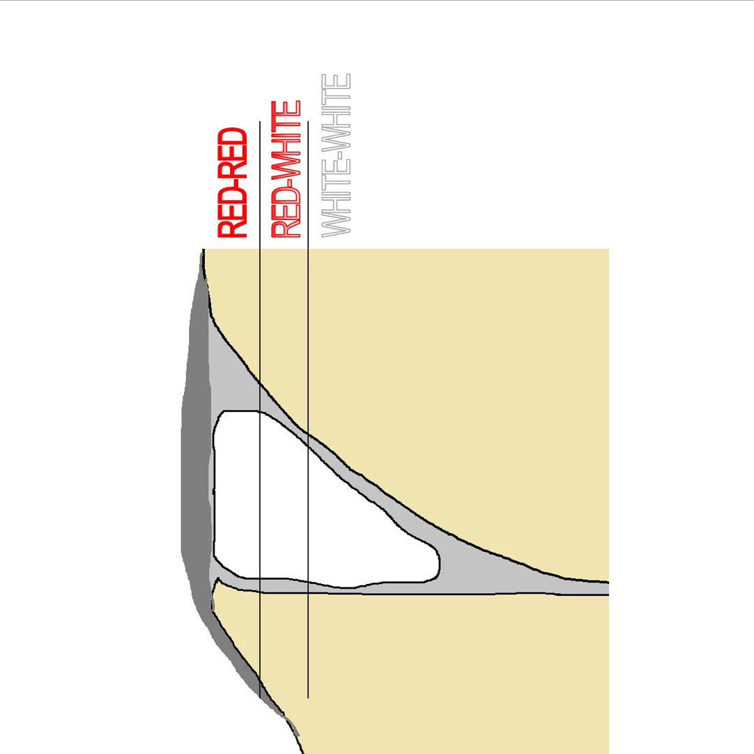 Meniscal Zones