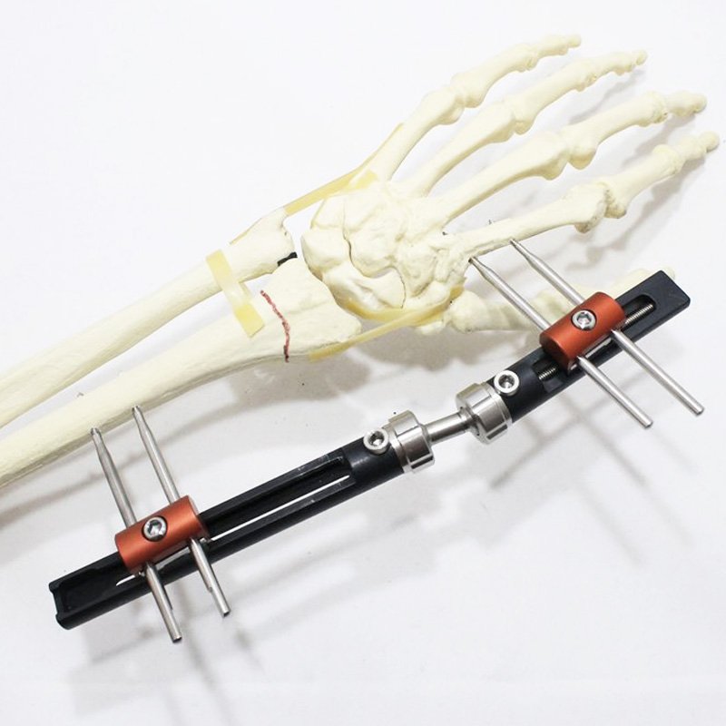 PENEF - Pennig Type Wrist Fixator - Monolateral Dynamic Wrist Fixator