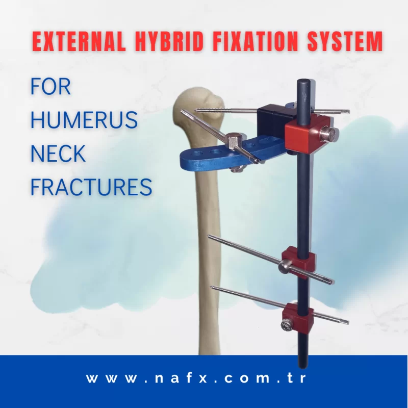 Humerus Proximal Hybrid Fixator