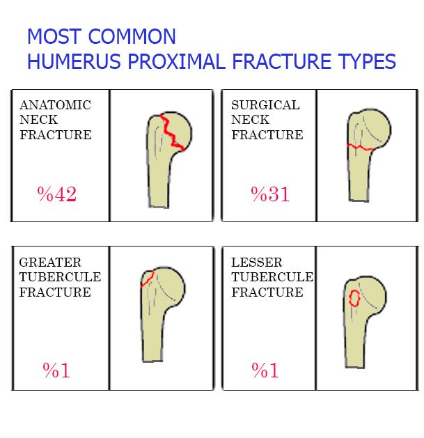 Humerus Proximal Hybrid Fixator